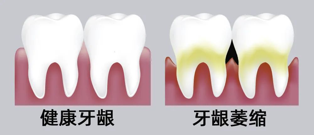 牙縫大露出“黑三角”，既塞牙又難看！還能恢復(fù)嗎？